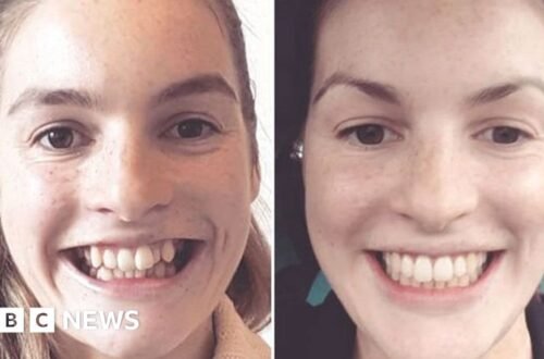 British People Teeth